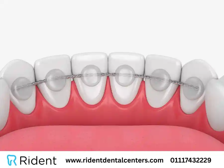 سعر مثبت الاسنان بعد التقويم